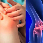 Arthritis>>மூட்டுவலி (கீல்வாதம்)<<பாகம் 2